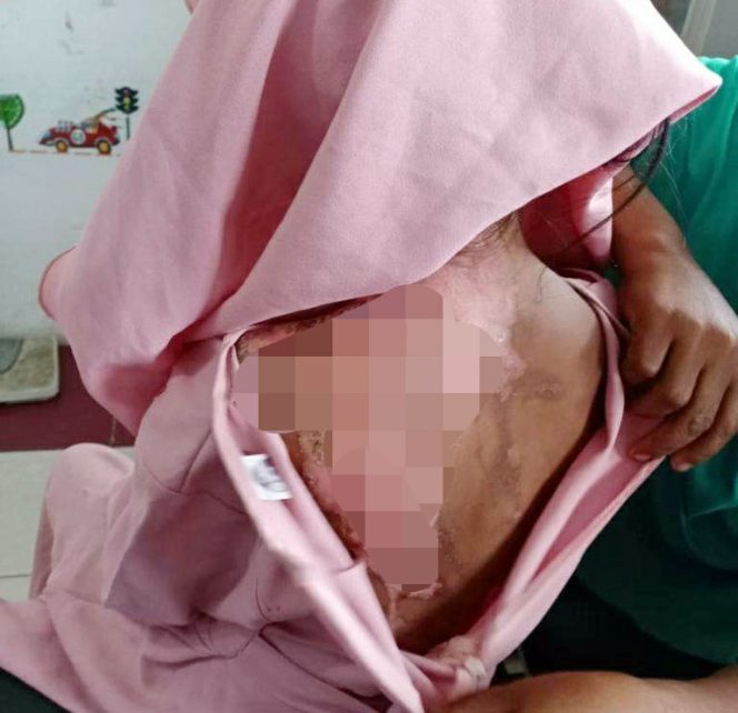 
 Teks Foto : Tubuh NU (13) melepuh diduga disiram air panas oleh ibu kandungnya.
