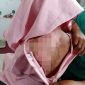 Teks Foto : Tubuh NU (13) melepuh diduga disiram air panas oleh ibu kandungnya.