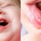 Obat sariawan anak