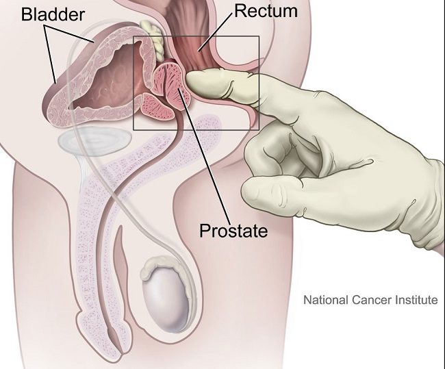 
 Kerusakan Organ Tubuh Karena Kanker Prostat: Ketahui Sebelum Terlambat